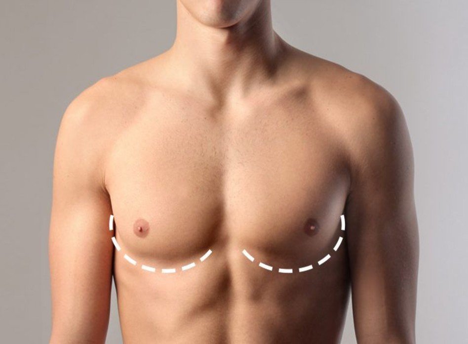 Gynecomastia Correction