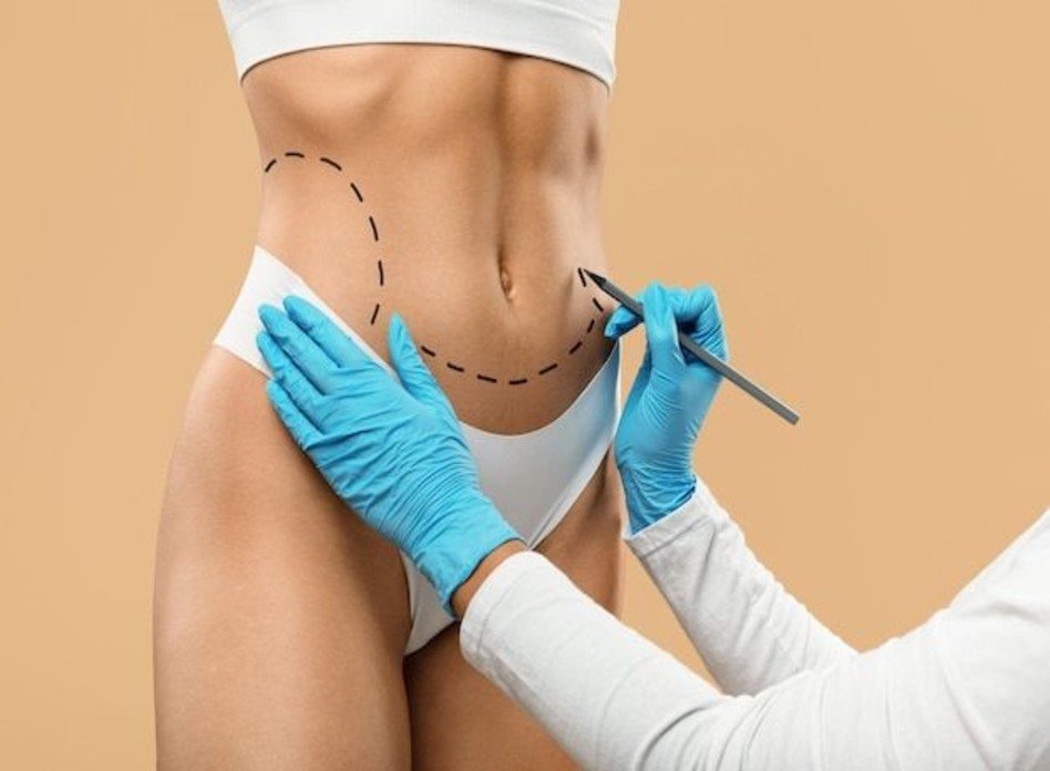 Liposuction Stubborn Fat Removal