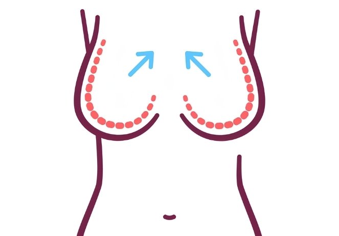 Breast Reduction