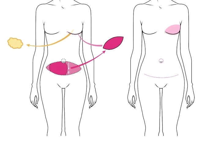 DIEP Flap Reconstruction