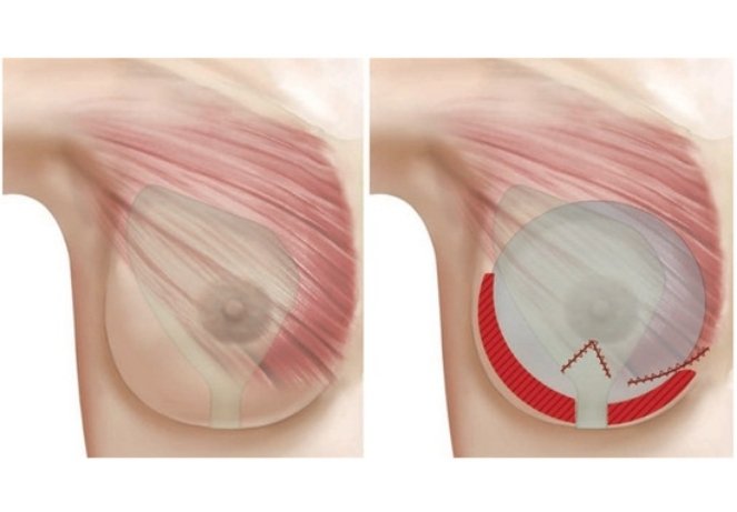 Augmentation Mastopexy