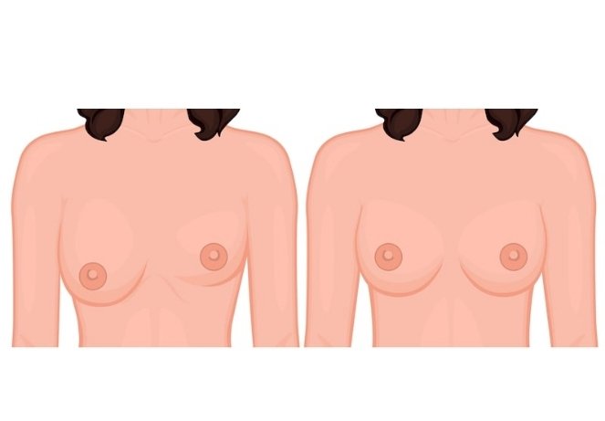 Breast Asymmetry & Congenital Correction