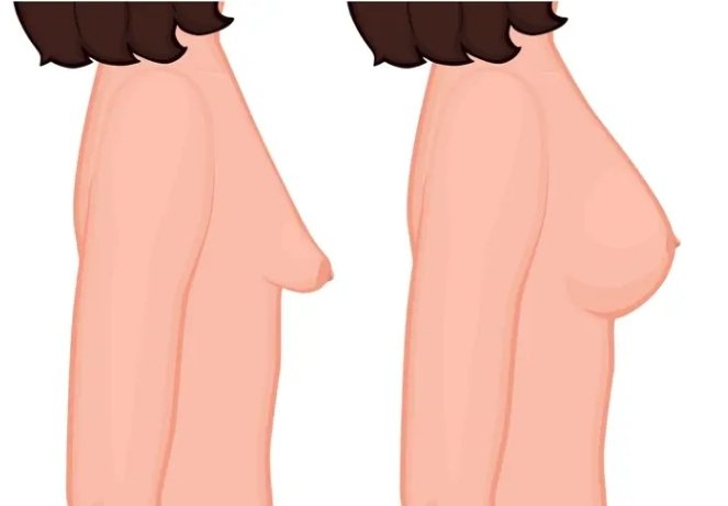 Tuberous (Constricted) Breast Correction