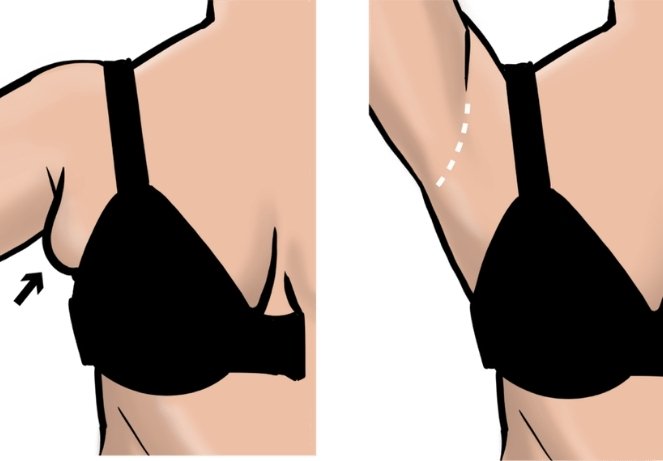 Accessory Breast Removal (Axillary)