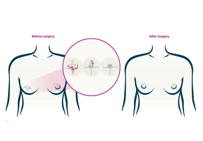 Cosmetic Nipple Surgery