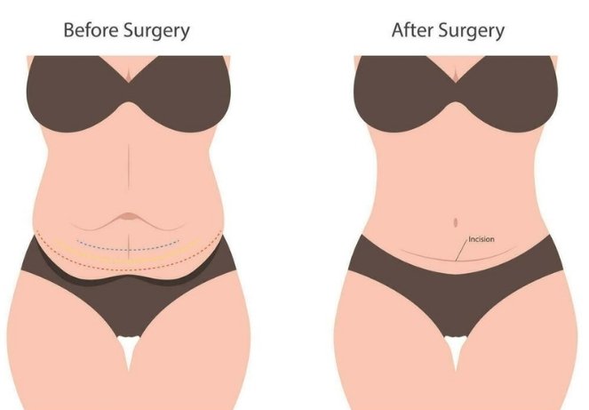 Abdominoplasty (Tummy Tuck) ​