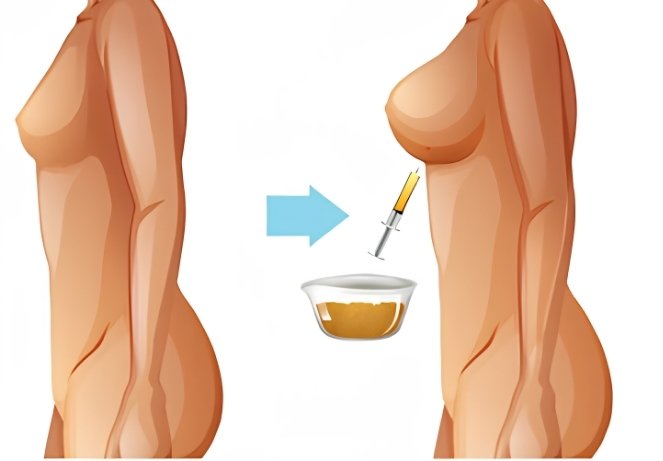 Lipo-Filling / Fat Grafting
