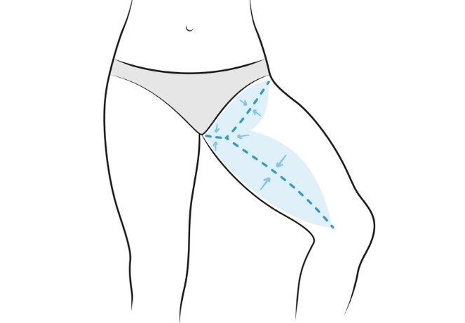 Thigh Lift