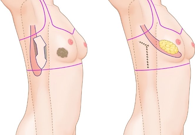 Latissimus Dorsi (LD) Flap Reconstruction