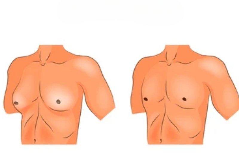 Gynecomastia Correction