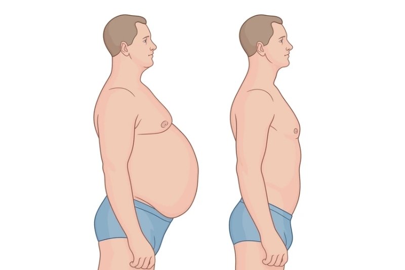 Post-Weight-Loss Body Contouring for Men