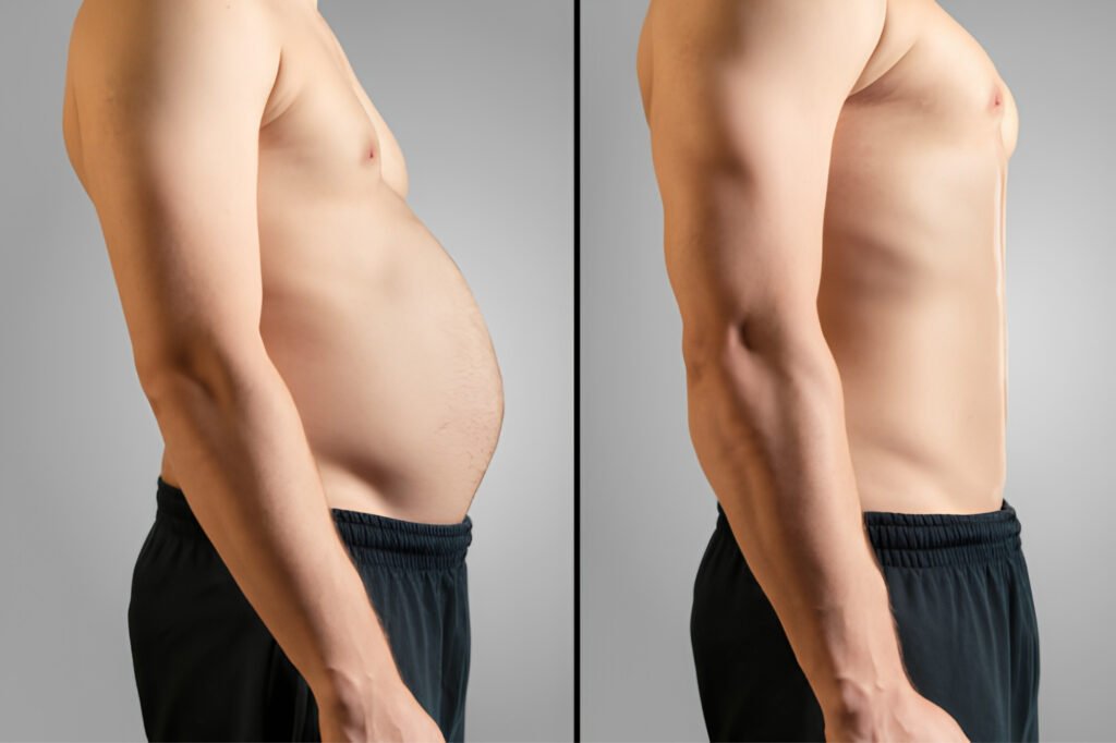 Post-Weight-Loss