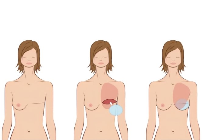Implant-Based Breast Reconstruction