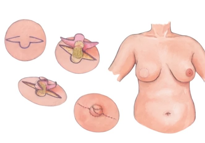 Nipple Reconstruction