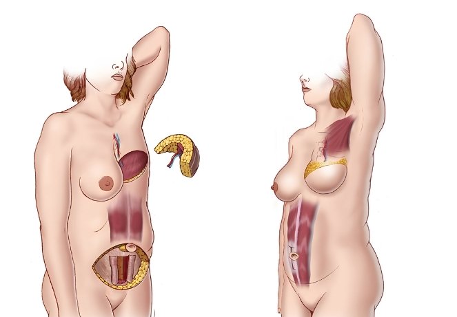 Prophylactic Mastectomy & Reconstruction