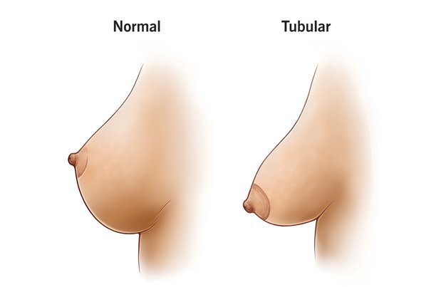 Breast Correction in Mumbai