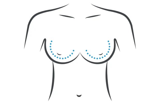 Revisional Breast Augmentation in Mumbai
