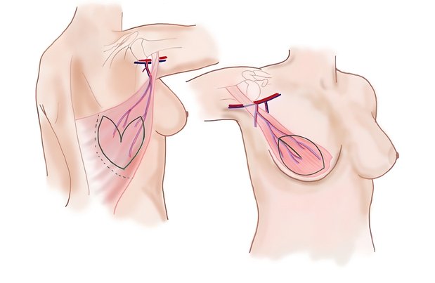 Latissimus Dorsi Flap Reconstruction