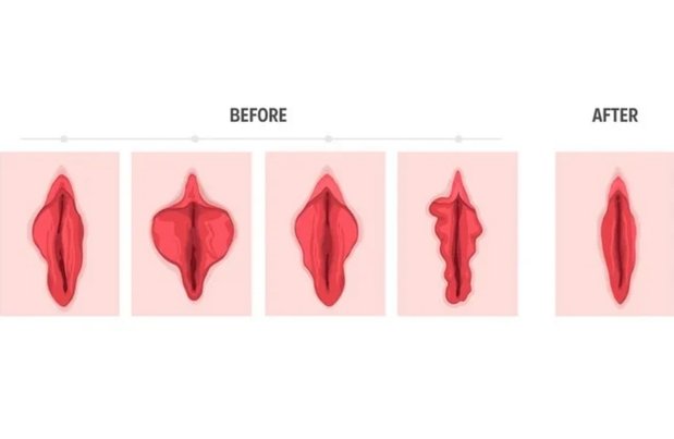 Labiaplasty Surgery in Mumbai​