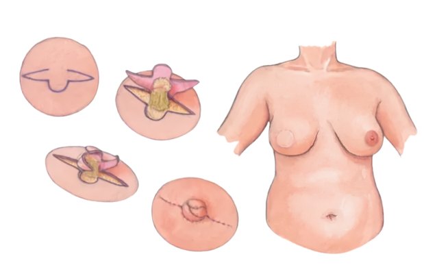 Nipple Reconstruction