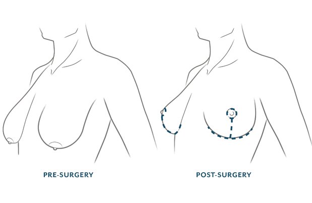 Augmentation Mastopexy in Mumbai​
