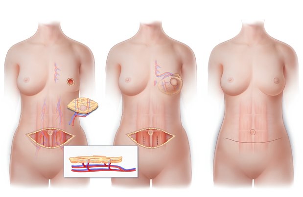 DIEP Flap Breast Reconstruction