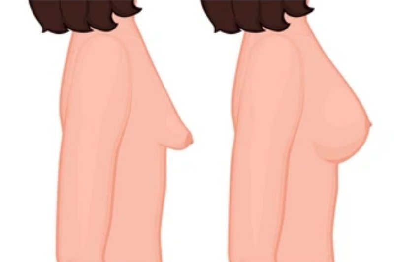 Tuberous (Constricted) Breast Correction in Mumbai