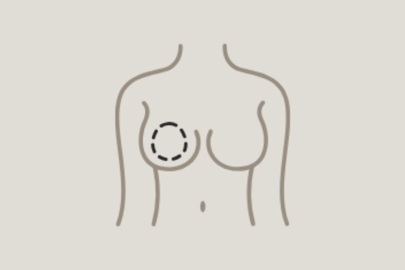 Revisional Breast Augmentation in Mumbai