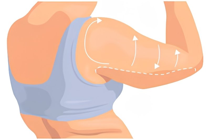 Brachioplasty (Arm Lift) Surgery in Mumbai​