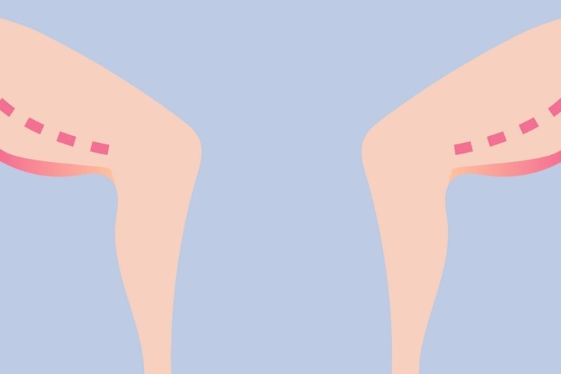 Thigh Lift Surgery in Mumbai