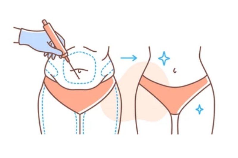 Liposuction (Stubborn Fat Removal) in Mumbai