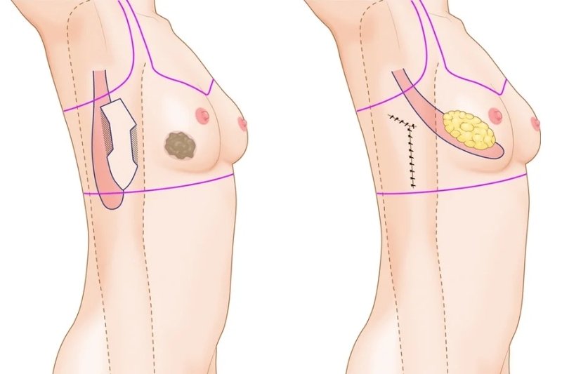 Latissimus Dorsi Flap Reconstruction in Mumbai