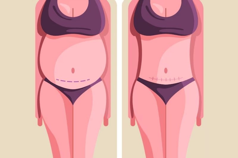 Mommy Makeover Surgery in Mumbai​
