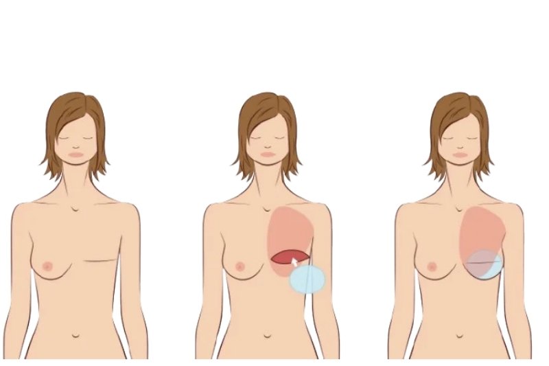 Implant-Based Breast Reconstruction in Mumbai