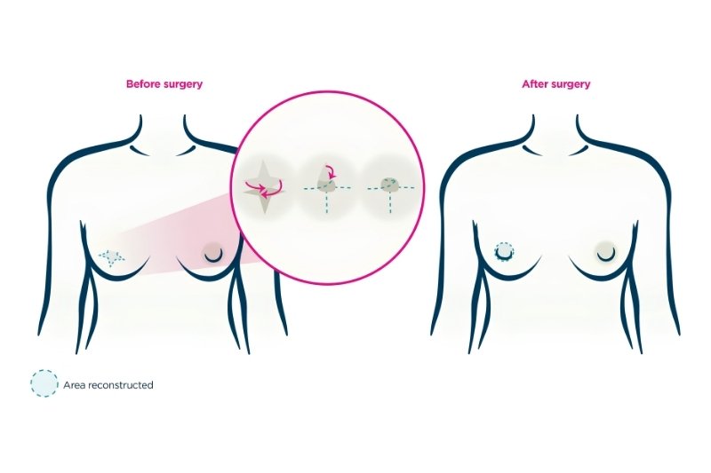 Nipple Reconstruction Surgery in Mumbai