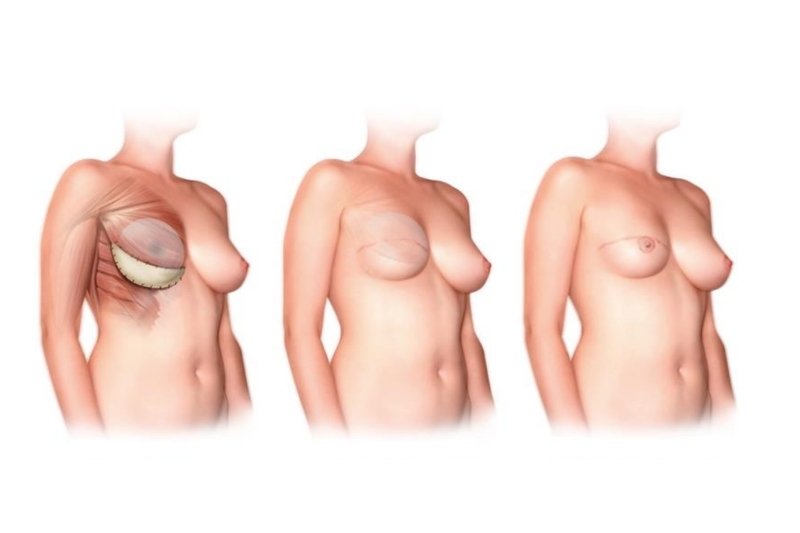 Prophylactic Mastectomy & Reconstruction in Mumbai