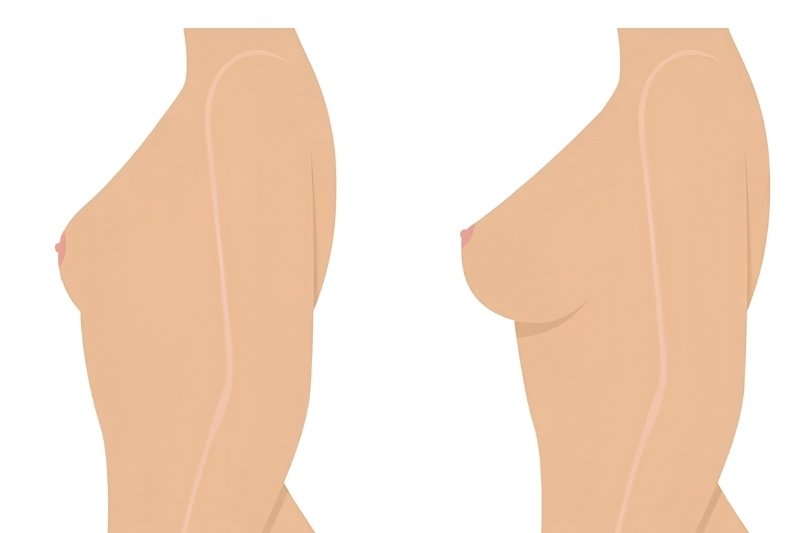 Augmentation Mastopexy in Mumbai​