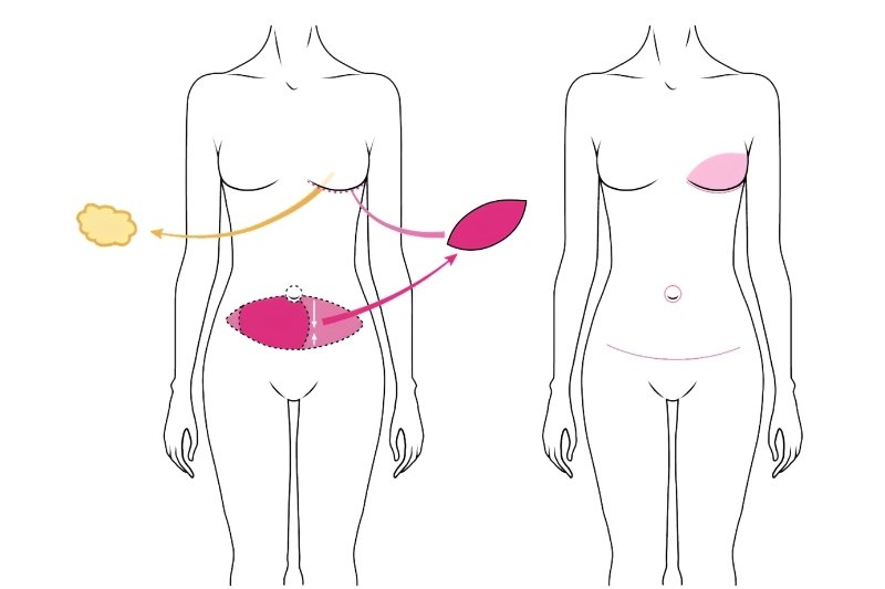 DIEP Flap Breast Reconstruction in Mumbai